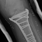 Knee_Screws3.jpg