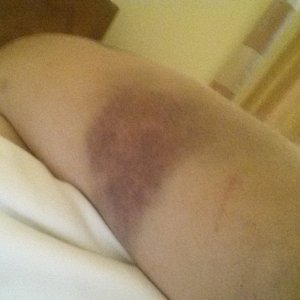 A little battle scar