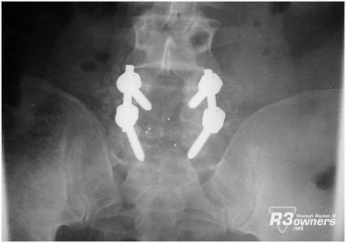 Lumbar-Fusion 380x267